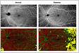 Wide-field optical coherence tomography angiography for th